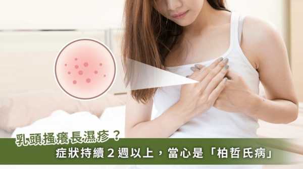 备孕期乳头痒(怀孕后乳头痒怎么办) 第3张 备孕期乳头痒(怀孕后乳头痒怎么办) 第3张