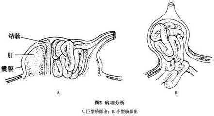 胎儿脐膨出自己长好了(脐膨出是什么原因引起的) 第1张 胎儿脐膨出自己长好了(脐膨出是什么原因引起的) 第1张