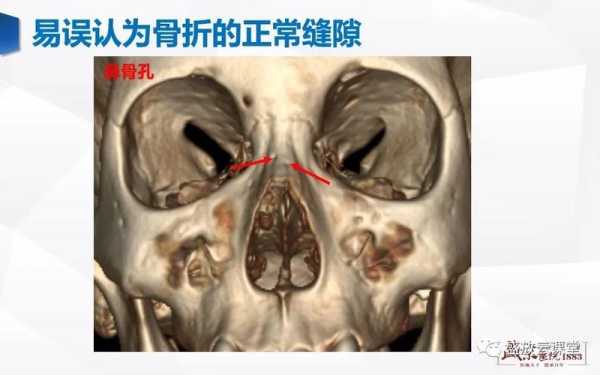 鼻骨短是什么意思,24周胎儿鼻骨长标准对照表 第2张 鼻骨短是什么意思,24周胎儿鼻骨长标准对照表 第2张