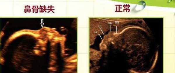 鼻骨短是什么意思,24周胎儿鼻骨长标准对照表 第3张 鼻骨短是什么意思,24周胎儿鼻骨长标准对照表 第3张
