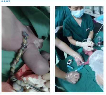 胎儿死在腹中怎么处理（胎儿死在腹中需要手术吗）  第3张