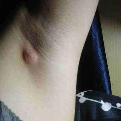 怀孕后腋下长了个小疙瘩怎么回事,孕期长小疙瘩怎么办 第2张 怀孕后腋下长了个小疙瘩怎么回事,孕期长小疙瘩怎么办 第2张