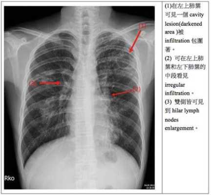 右肺上叶囊性灶是怎么回事,胎儿右肺囊性瘤影响不育吗 第2张 右肺上叶囊性灶是怎么回事,胎儿右肺囊性瘤影响不育吗 第2张