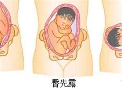 胎儿在肚子里翘屁股图(胎儿在肚子里翘屁股图片大全) 第2张 胎儿在肚子里翘屁股图(胎儿在肚子里翘屁股图片大全) 第2张