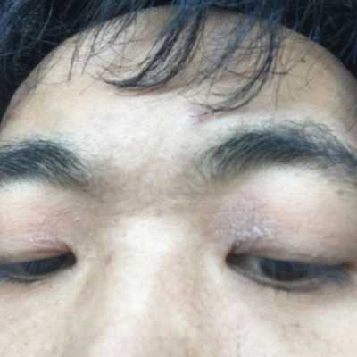 孕期皮肤瘙痒图片(孕妇眼睛痒怎么办) 第2张 孕期皮肤瘙痒图片(孕妇眼睛痒怎么办) 第2张