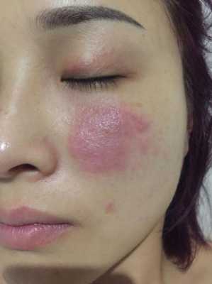孕期皮肤瘙痒图片(孕妇眼睛痒怎么办) 第3张 孕期皮肤瘙痒图片(孕妇眼睛痒怎么办) 第3张
