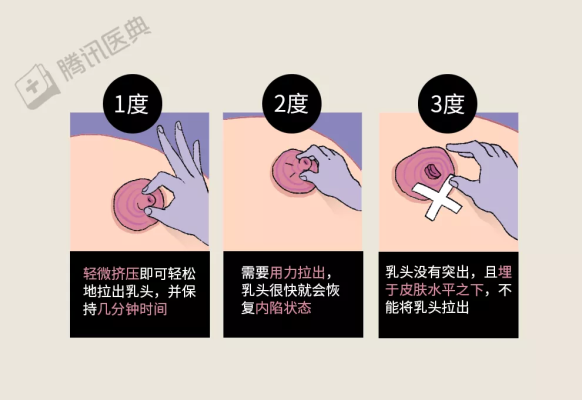 孕期乳头内陷怎么办?这是什么情况啊,孕期乳头内陷图片 第1张 孕期乳头内陷怎么办?这是什么情况啊,孕期乳头内陷图片 第1张