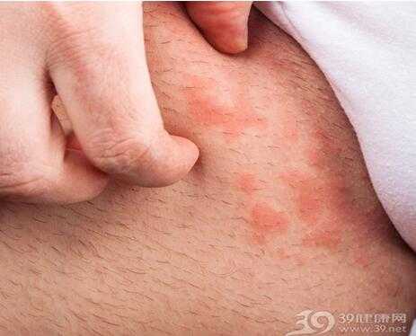 孕期阴毛处痒  第3张