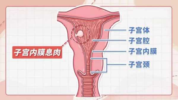 孕期宫颈息肉怎么办,孕期子宫息肉注意事项 第2张 孕期宫颈息肉怎么办,孕期子宫息肉注意事项 第2张