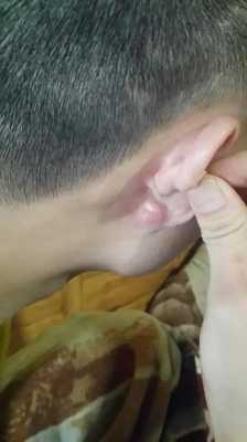 耳朵下边长痘是怎么回事,孕期下面长痘痘了还痒怎么办 第2张 耳朵下边长痘是怎么回事,孕期下面长痘痘了还痒怎么办 第2张