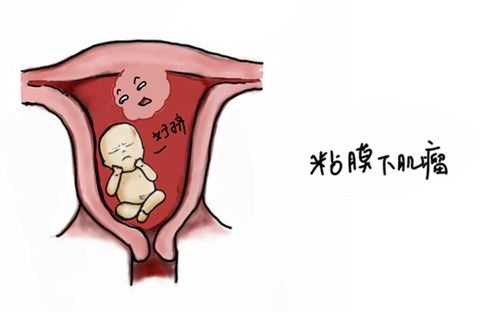 孕期子宫肌瘤变大(孕期子宫肌瘤变大了怎么办) 第1张 孕期子宫肌瘤变大(孕期子宫肌瘤变大了怎么办) 第1张