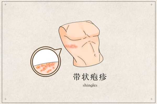 带状疱疹会对孕妇中的胎儿造成影响吗,孕期疱疹病毒感染 第1张 带状疱疹会对孕妇中的胎儿造成影响吗,孕期疱疹病毒感染 第1张