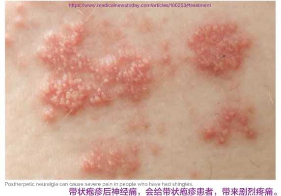 带状疱疹会对孕妇中的胎儿造成影响吗,孕期疱疹病毒感染 第2张 带状疱疹会对孕妇中的胎儿造成影响吗,孕期疱疹病毒感染 第2张