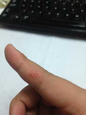 孕期被狗咬了(孕期狗咬了打针影响宝宝吗) 第2张 孕期被狗咬了(孕期狗咬了打针影响宝宝吗) 第2张