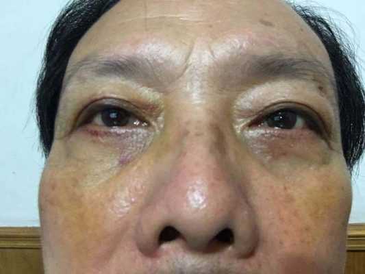 怀孕27周心脏主血管细怎么办,孕期胸部青筋明显是什么原因 第2张 怀孕27周心脏主血管细怎么办,孕期胸部青筋明显是什么原因 第2张