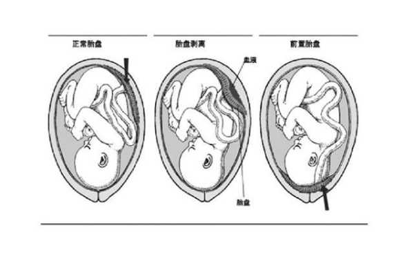 胎儿在前壁好还是后壁好(怀孕胎儿位于在前壁和后壁有什么区别吗) 第2张 胎儿在前壁好还是后壁好(怀孕胎儿位于在前壁和后壁有什么区别吗) 第2张