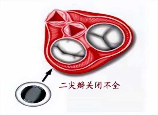 肺动脉瓣轻度返流与二、三尖瓣轻度返流,严重吗?如何治疗,胎儿肺动脉瓣少量返流伴迷走右锁骨下动脉 第1张 肺动脉瓣轻度返流与二、三尖瓣轻度返流,严重吗?如何治疗,胎儿肺动脉瓣少量返流伴迷走右锁骨下动脉 第1张