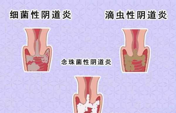 孕期白带黄稠(白带发黄粘稠是怎么回事) 第3张 孕期白带黄稠(白带发黄粘稠是怎么回事) 第3张