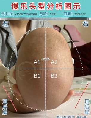 四个月宝宝舟状头还能矫正吗,胎儿颅骨呈舟状正常吗图片 第1张 四个月宝宝舟状头还能矫正吗,胎儿颅骨呈舟状正常吗图片 第1张