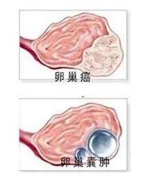 孕期卵巢囊肿怎么办啊,孕期发现卵巢囊肿怎么办啊?  第1张