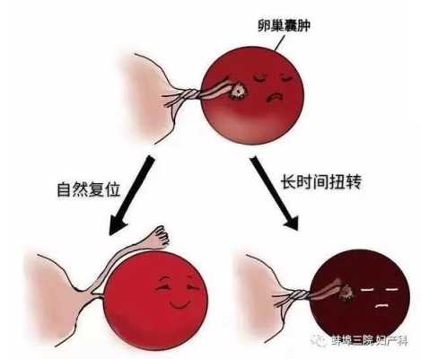 孕期卵巢囊肿怎么办啊,孕期发现卵巢囊肿怎么办啊?  第3张