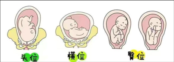 胎儿呈屈曲团抱位图片（胎儿呈屈曲团抱位姿势图）  第3张