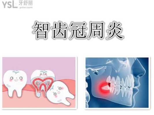 孕妇得了智齿冠周炎,该如何治疗,孕妇冠周炎怎么办 第1张 孕妇得了智齿冠周炎,该如何治疗,孕妇冠周炎怎么办 第1张