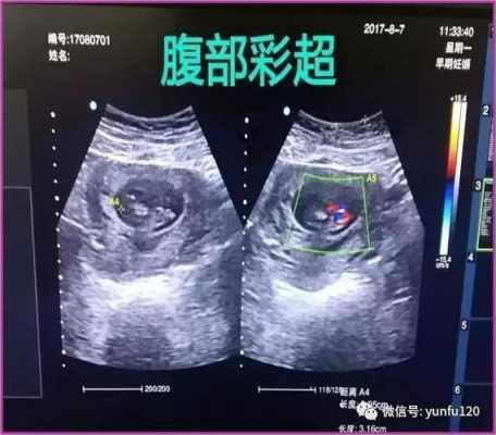 阴超对胎儿有什么危害（阴超对胎儿的危害）  第1张