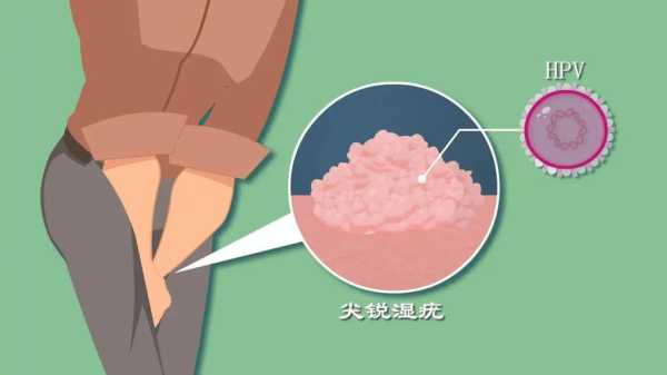 尖锐湿庞会影响胎儿吗(尖瑞湿疣传染下一代吗) 第2张 尖锐湿庞会影响胎儿吗(尖瑞湿疣传染下一代吗) 第2张