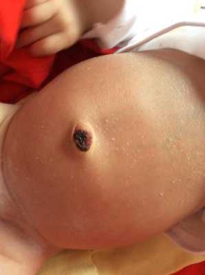 胎儿脸朝上是什么原因(孕妈肚脐凹进或凸出跟什么有关) 第2张 胎儿脸朝上是什么原因(孕妈肚脐凹进或凸出跟什么有关) 第2张