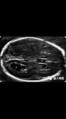 胎儿侧脑室宽怎么缓解,胎儿右脑室宽是什么引起的 第2张 胎儿侧脑室宽怎么缓解,胎儿右脑室宽是什么引起的 第2张