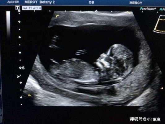 孕妇系统B超具体检查内容,孕期产检b超对胎儿有影响吗 第2张 孕妇系统B超具体检查内容,孕期产检b超对胎儿有影响吗 第2张