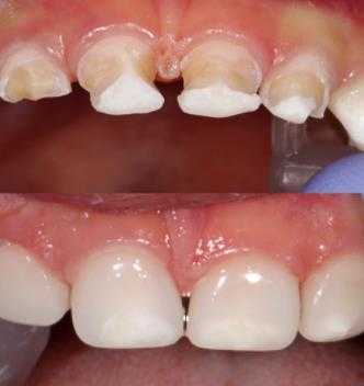 孕期能补牙洞吗(孕期能补牙洞吗牙很痛) 第3张 孕期能补牙洞吗(孕期能补牙洞吗牙很痛) 第3张