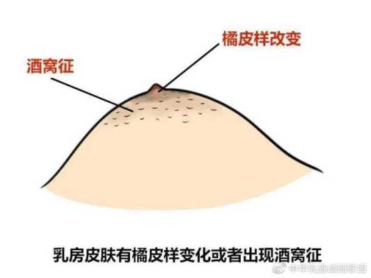 孕期乳头痒怎么缓解(怀孕期间乳头痒怎么回事) 第1张 孕期乳头痒怎么缓解(怀孕期间乳头痒怎么回事) 第1张