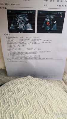 胎儿心脏卵圆孔正常值(胎儿心脏卵圆孔正常值是多少?) 第1张 胎儿心脏卵圆孔正常值(胎儿心脏卵圆孔正常值是多少?) 第1张