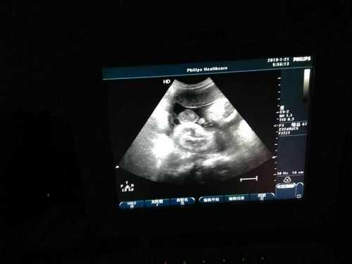怀孕32周胎儿腹中视频(手机存储卡的视频无法播放) 第2张 怀孕32周胎儿腹中视频(手机存储卡的视频无法播放) 第2张
