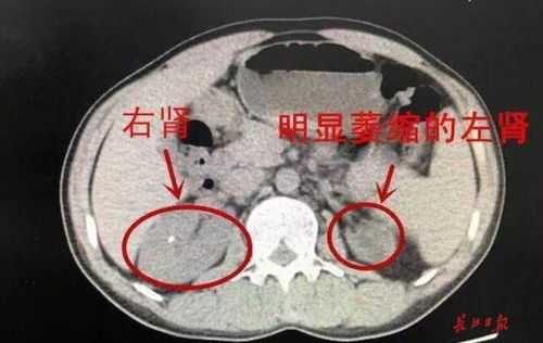 胎儿双肾大小不一致左肾3.4*2.0cm，右肾2.7*1.6cm有影响吗,胎儿双肾偏大是畸形吗怎么治疗  第2张