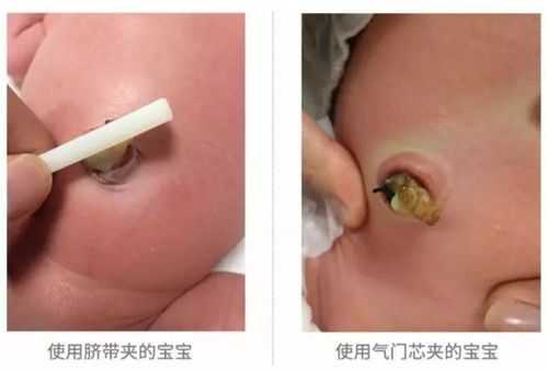 胎儿出生后脐带怎么办(胎儿出生后脐带怎么处理) 第1张 胎儿出生后脐带怎么办(胎儿出生后脐带怎么处理) 第1张