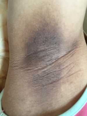 怀孕腋下变黑怎么办,孕期腋下变黑怎么恢复正常 第3张 怀孕腋下变黑怎么办,孕期腋下变黑怎么恢复正常 第3张