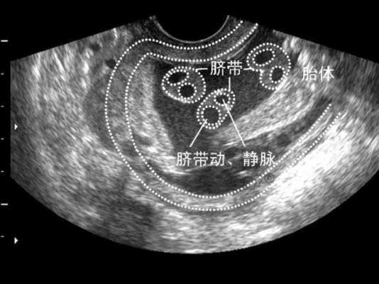胎儿单脐带动脉能要吗(单脐带动脉胎儿发育都很好) 第1张 胎儿单脐带动脉能要吗(单脐带动脉胎儿发育都很好) 第1张