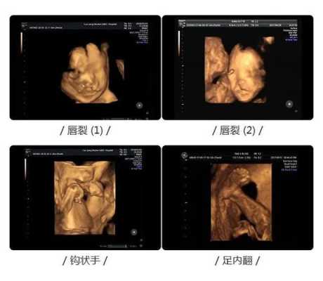 大排畸什么念,大排畸异常的胎儿征兆有哪些 第3张 大排畸什么念,大排畸异常的胎儿征兆有哪些 第3张