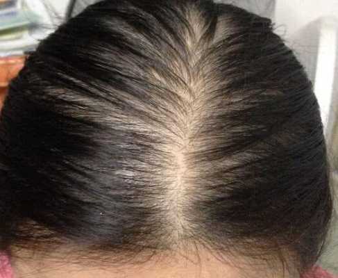 孕妇掉头发厉害的原因有哪些,孕期老掉头发什么原因  第2张