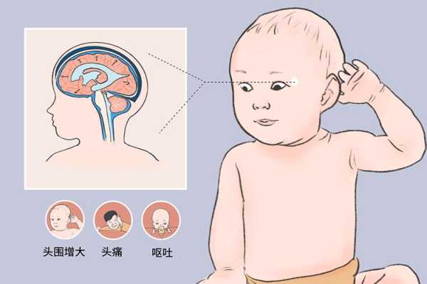 胎儿脑积水会怎么样(胎儿脑积水怎么样会自己吸收吗) 第1张 胎儿脑积水会怎么样(胎儿脑积水怎么样会自己吸收吗) 第1张