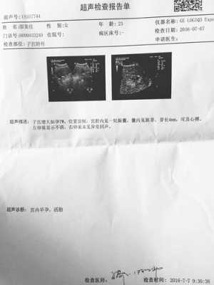 孕45天胎儿发育情况到底是怎样的?孕早期时候,需要怎么检查,怀孕五十多天的胎儿图 第1张 孕45天胎儿发育情况到底是怎样的?孕早期时候,需要怎么检查,怀孕五十多天的胎儿图 第1张