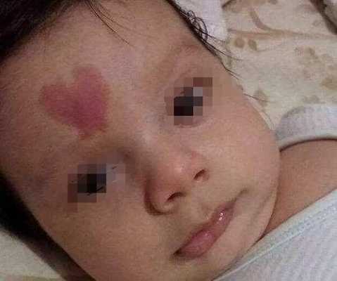 孕妇撞到肚子会有胎记吗,胎儿胎记能照出来吗图片 第2张 孕妇撞到肚子会有胎记吗,胎儿胎记能照出来吗图片 第2张