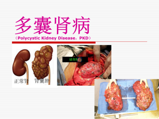 右肾多囊的胎儿能要吗(右肾多囊的胎儿能要吗女性) 第2张 右肾多囊的胎儿能要吗(右肾多囊的胎儿能要吗女性) 第2张