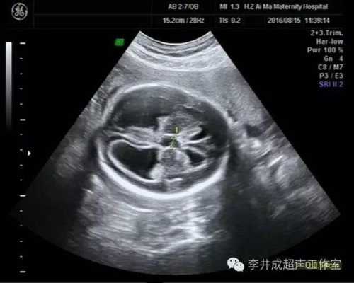 胎儿侧脑室增宽数值没变生下来会吸收吗,胎儿脑室增宽会吸收吗会胎停吗 第3张 胎儿侧脑室增宽数值没变生下来会吸收吗,胎儿脑室增宽会吸收吗会胎停吗 第3张