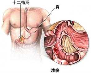 十二指肠溃疡毛细血管扩张是不是有少量出血,胎儿十二指肠扩张好了会复发吗  第2张