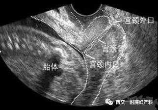 宫颈口长度的正常范围是多少,孕期正常宫颈长度是多少mm 第2张 宫颈口长度的正常范围是多少,孕期正常宫颈长度是多少mm 第2张