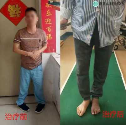 婴儿出生时双脚掌内翻可以效正吗,胎儿双足内翻能治好吗  第2张